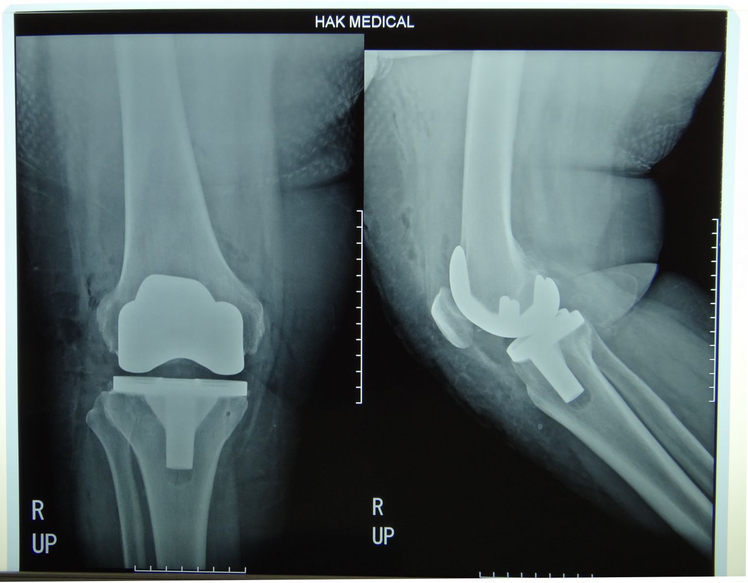 Инвалидность после эндопротезирования. Тибиальный компонент эндопротеза коленного сустава. Пателла Альта коленного сустава рентген. Рентген снимки после эндопротезирования коленного сустава. Нестабильность эндопротеза коленного сустава рентген.