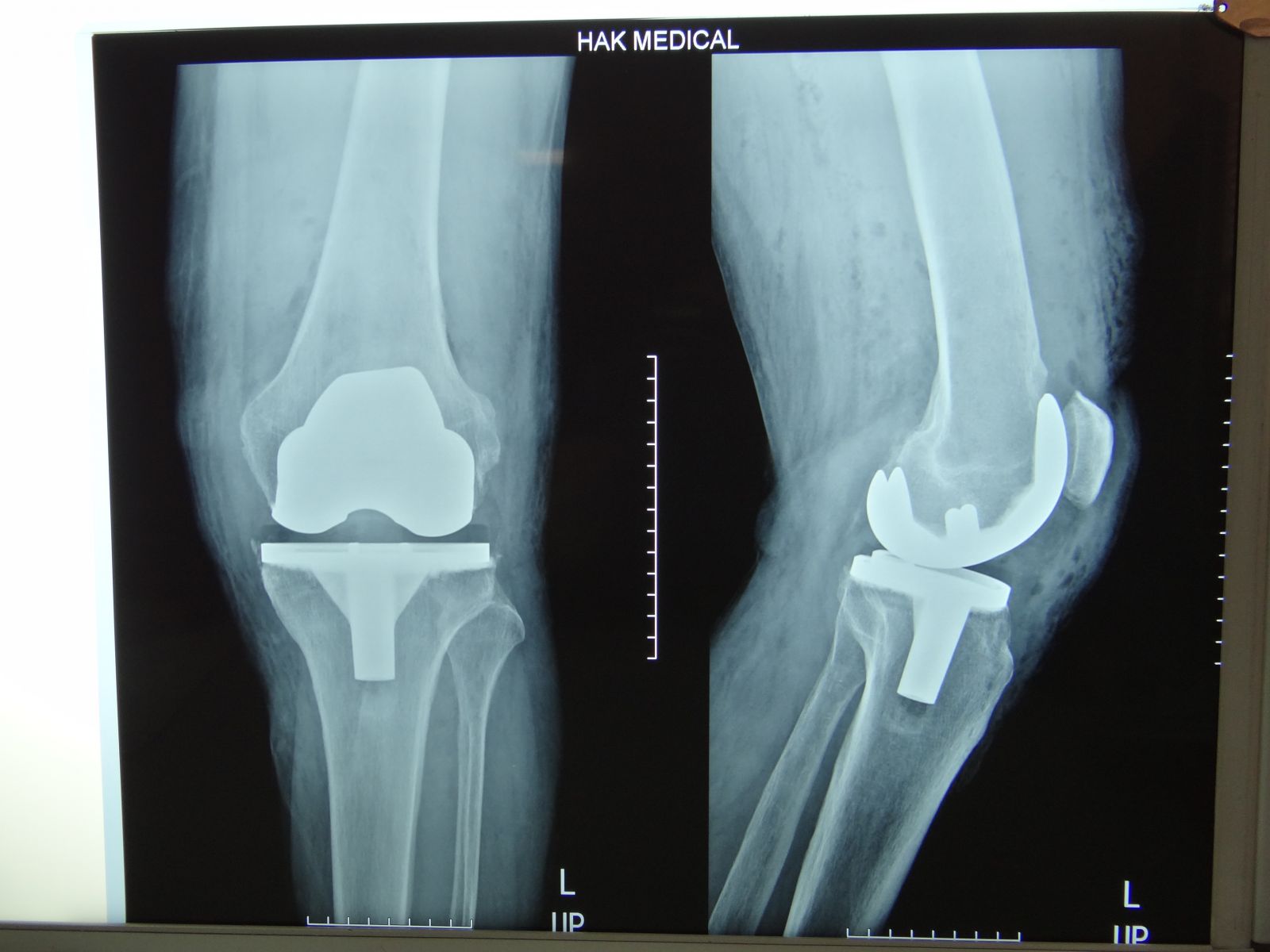 Почему колено после эндопротезирования. Спейсер коленного сустава рентген. Протез коленного сустава Антем. Эндопротезирование коленного сустава рентген. Рентген эндопротез коленного сустава топограмма.