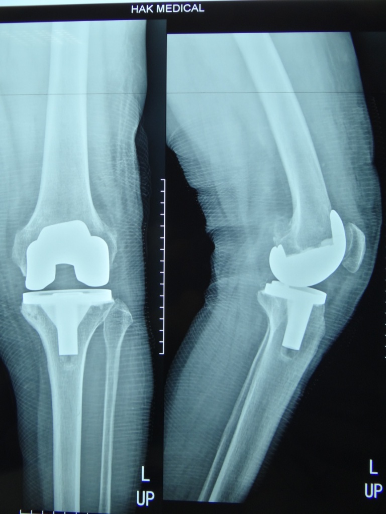 Почему колено после эндопротезирования. Модульный эндопротез коленного сустава. Ревизионные эндопротезы коленного сустава. Ревизионное эндопротезирование коленного сустава. Эндопротезирование коленного сустава рентген.